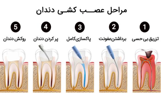 مراحل عص